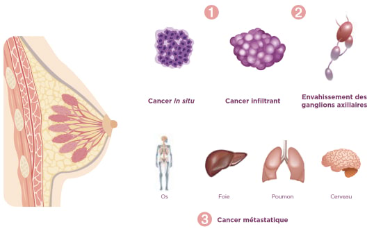 cancer metastatique