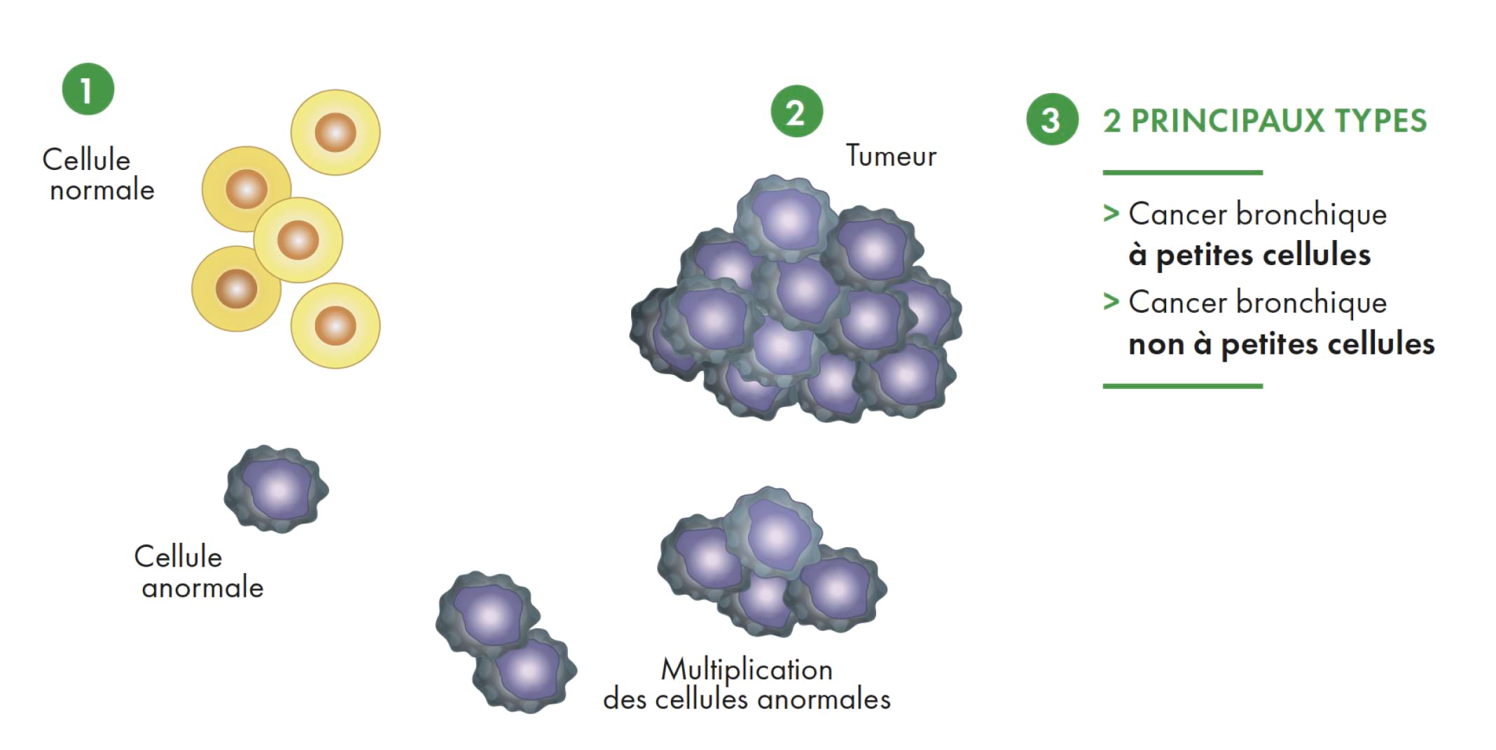 poumon cancer