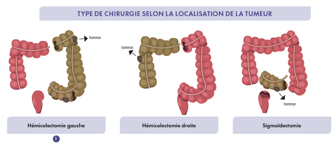Image Tumeur