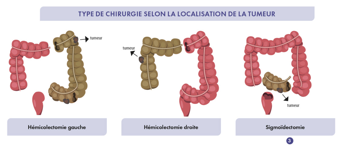 Image Tumeur