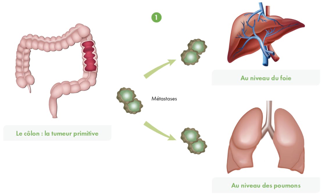 Le cancer du colon metastatique