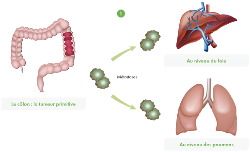 Le cancer du colon metastatique