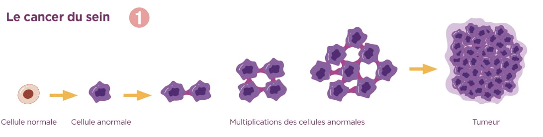 la cancer du sein