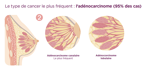 type de cancer