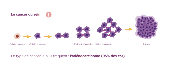 le cancer du sein